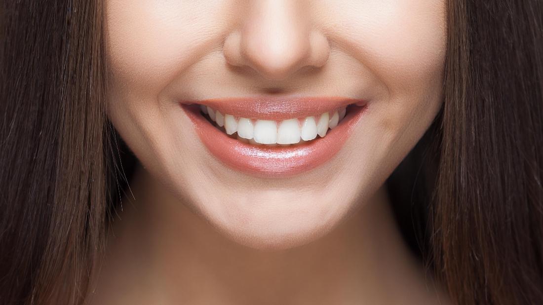 4 Reasons to Consider Veneers! Dentist in Indianapolis