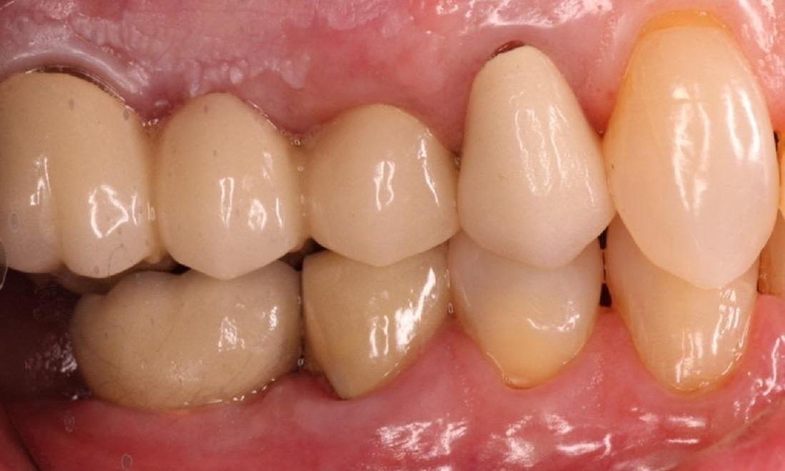 Permanent Tooth Replacement in Cumberland IN