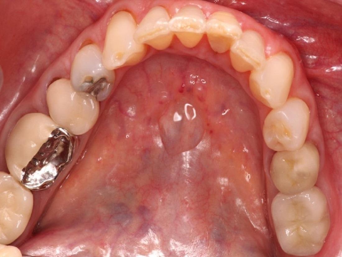 Permanent Tooth Replacement in Cumberland IN