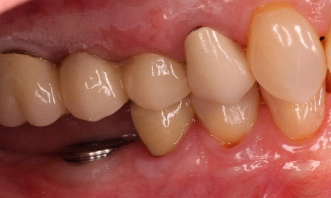 Tooth Replacement in Cumberland IN