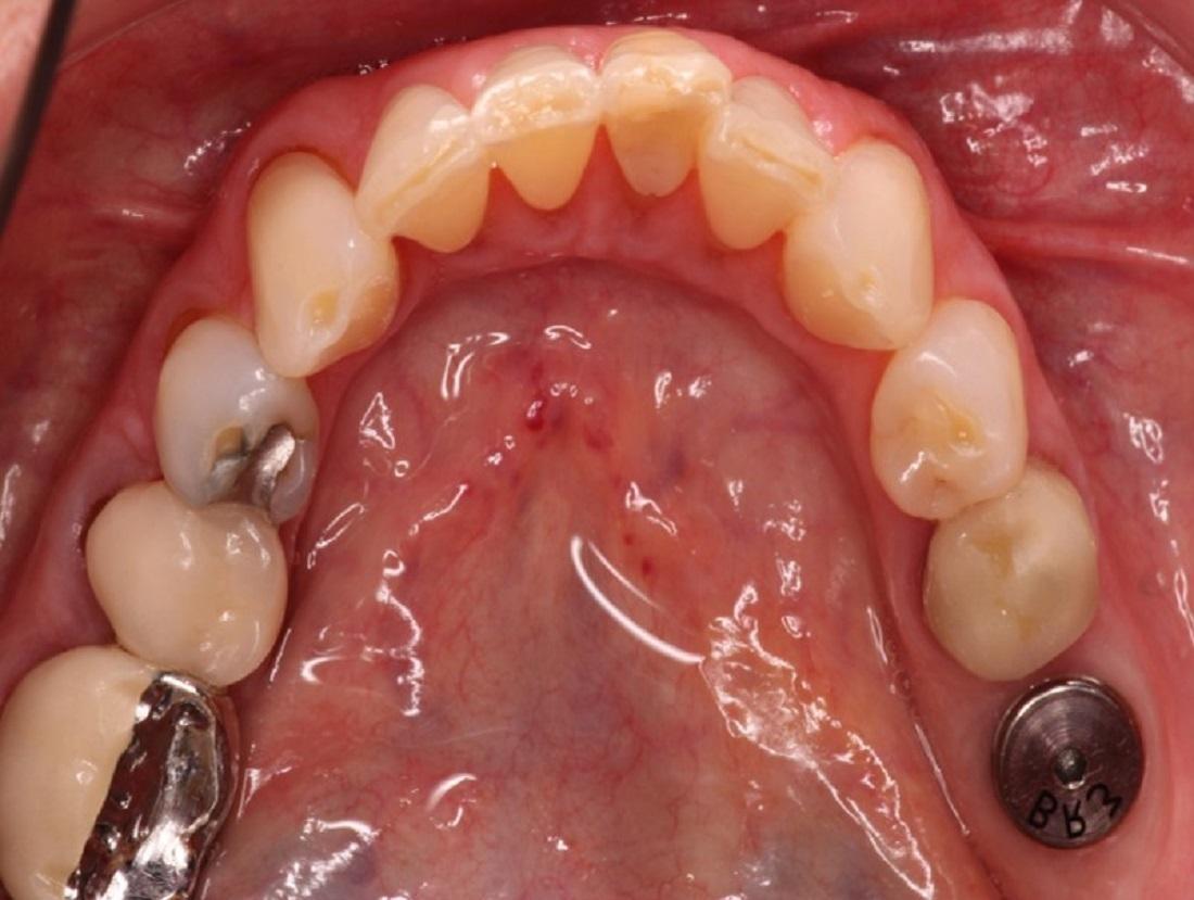 Tooth Replacement in Cumberland IN