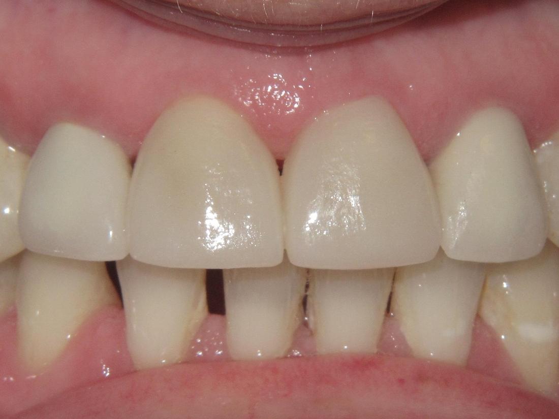 Porcelain Dental Crowns in Cumberland