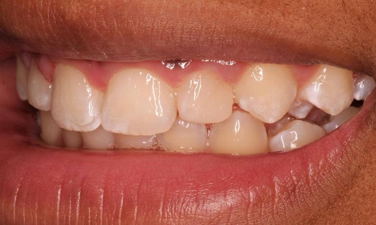 Fixing Gaps in Teeth in Cumberland