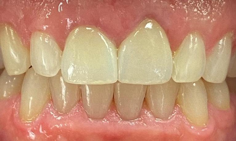 Cosmetic-Dentistry-After-Image