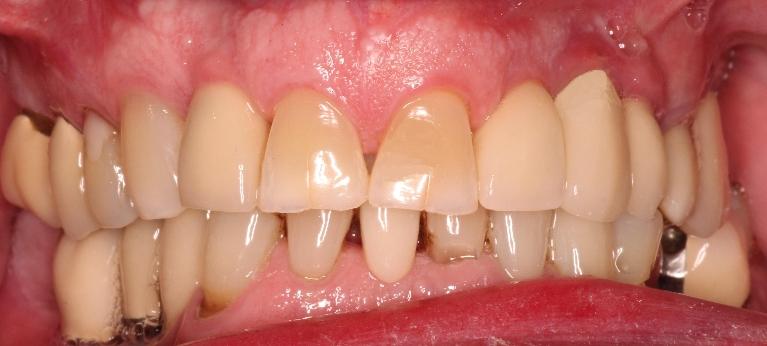 Tooth Replacement and Dental Crown in Indianapolis IN