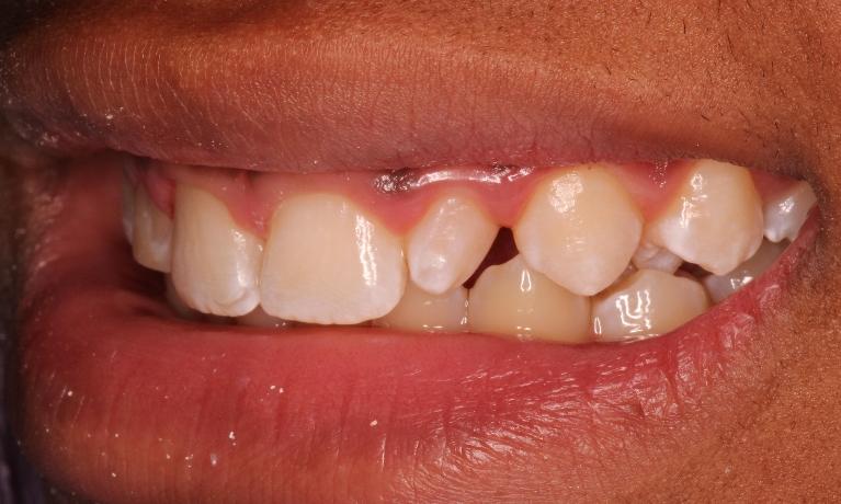 Fixing Gaps in Teeth in Indianapolis