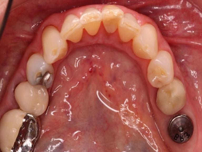 Implant-Before-Image