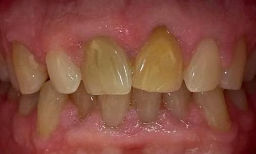Cosmetic-Dentistry-Before-Image