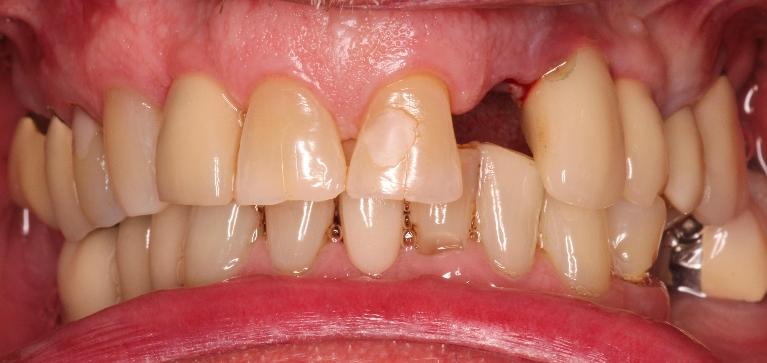 Tooth Replacement and Dental Crown in Cumberland IN