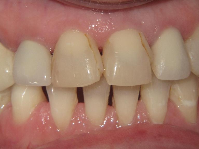 Porcelain-Crowns-Before-Image